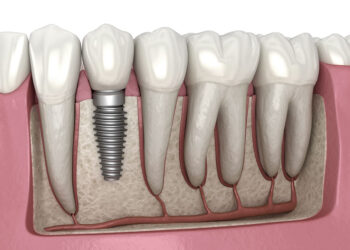 Dental implant in Turkey