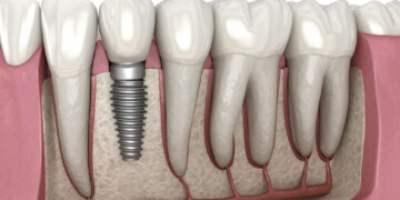 Dental implant in Turkey