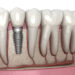 Dental implant in Turkey