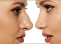 Pretty Nose with Rhinoplasty in Turkey 2022