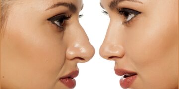 Pretty Nose with Rhinoplasty in Turkey 2022