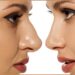 Pretty Nose with Rhinoplasty in Turkey 2022