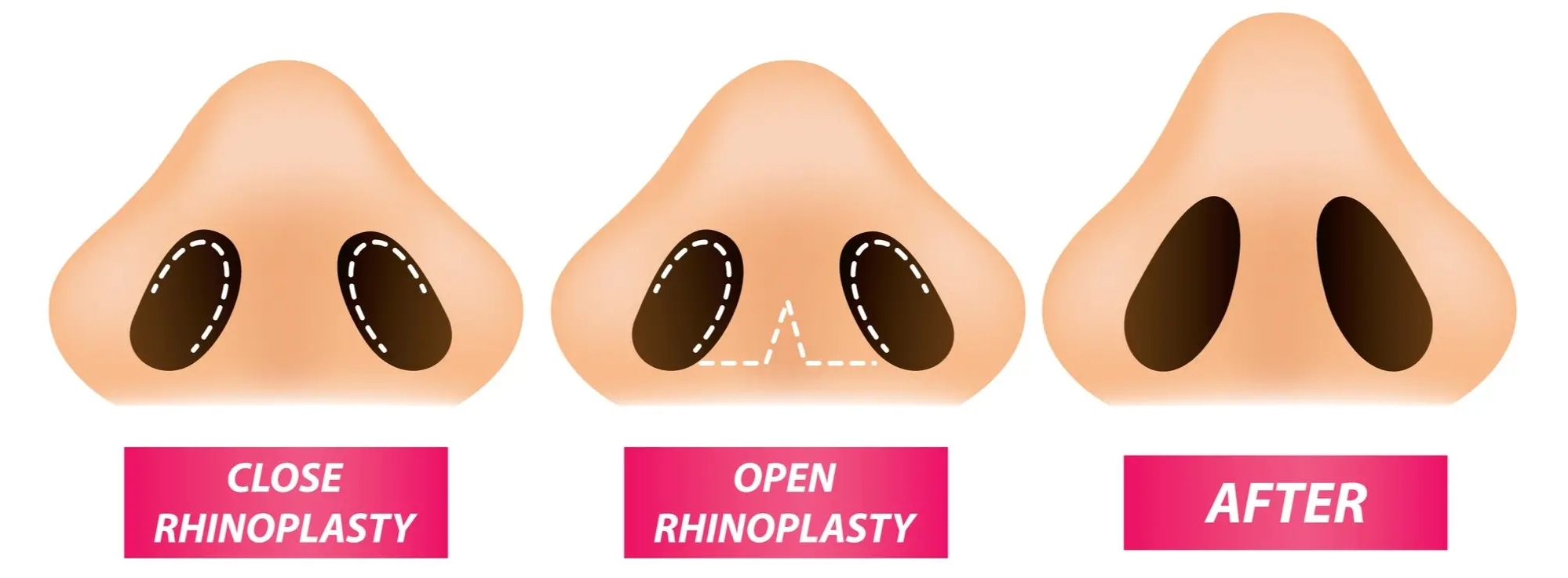 rhinoplasty in Turkey
