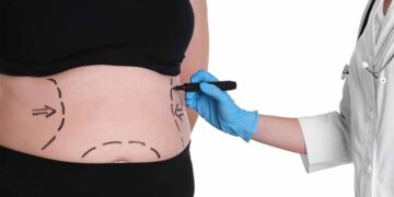 Effective Weight Loss Surgery in Turkey 2022