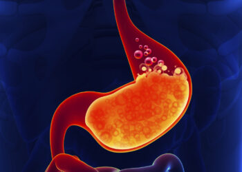 Reflux Surgery In Istanbul 2022