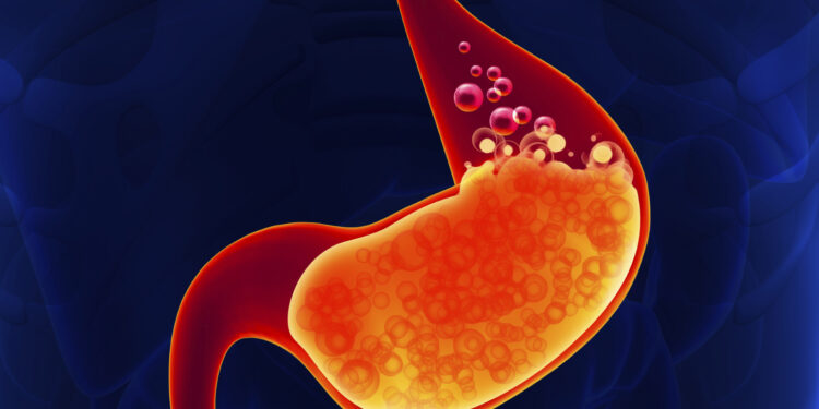 Reflux Surgery In Istanbul 2022