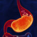 Reflux Surgery In Istanbul 2022
