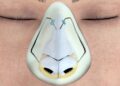 Ultrasonic rhinoplasty in Turkey