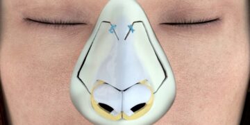 Ultrasonic rhinoplasty in Turkey