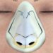 Ultrasonic rhinoplasty in Turkey