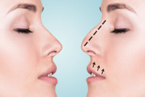 Ultrasonic rhinoplasty in turkey