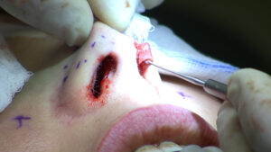 Ultrasonic rhinoplasty in Turkey