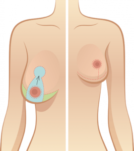 Breast Surgery in Istanbul