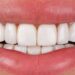 Dental treatment in Turkiye