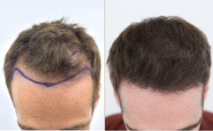 Different Types of Hair Transplants in Turkiye