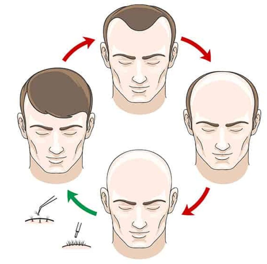 Different Types of Hair Transplants in Turkiye? - My Discovery Book