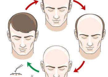 Different Types of Hair Transplants in Turkiye