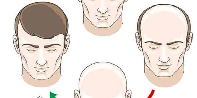 Different Types of Hair Transplants in Turkiye