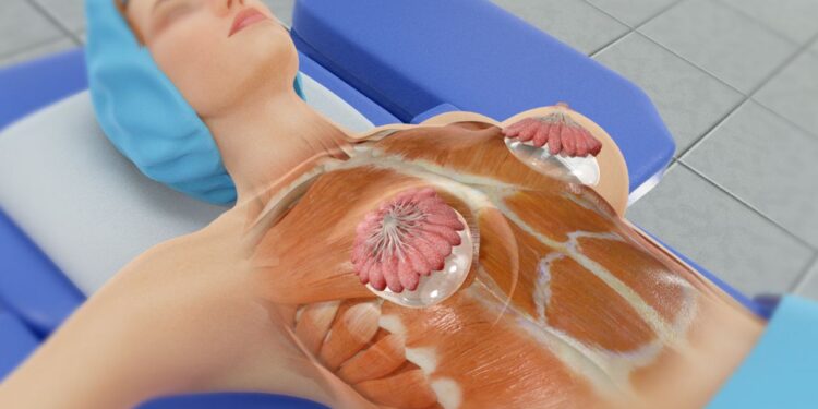 Breast Surgery in Istanbul
