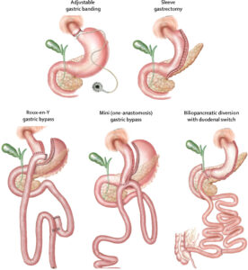 Bariatric Surgery in Turkiye