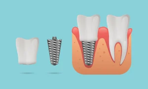 Dental Implants and Crowns in Turkiye