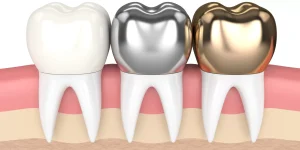 Dental Implants and Crowns in Turkiye