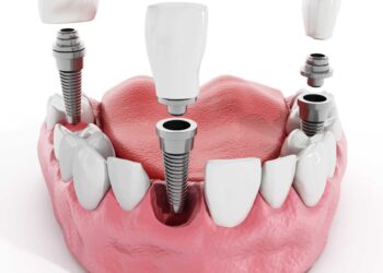 Dental Implants and Crowns in Turkiye