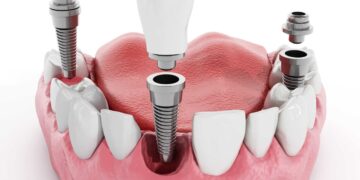 Dental Implants and Crowns in Turkiye