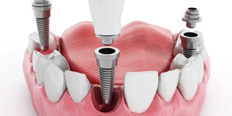 Dental Implants and Crowns in Turkiye
