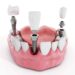 Dental Implants and Crowns in Turkiye