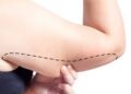 arm lift surgery in Turkiye