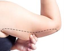 arm lift surgery in Turkiye