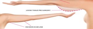 arm lift surgery in Turkiye