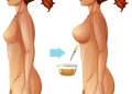 breast lipofilling in Turkiye