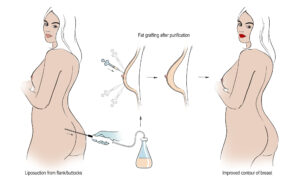 breast lipofilling in Turkiye