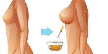 breast lipofilling in Turkiye