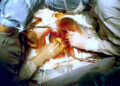 surgery in Turkiye